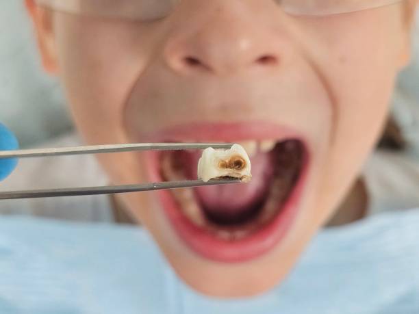 Best Emergency Dental Care for Broken or Chipped Teeth in Holton, KS